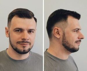 fade-for-receding-hairline